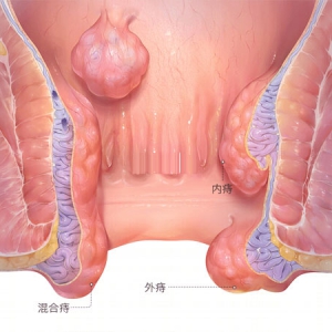 如果得了痔瘡不動(dòng)手術(shù)有什么好辦法 誰(shuí)有經(jīng)驗(yàn)